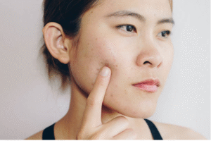 pimple treatment