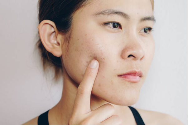 pimple treatment